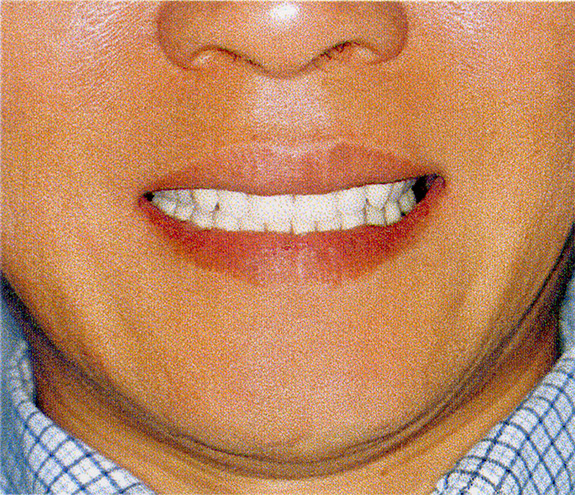 審美的な義歯は、自然なお口元となる。