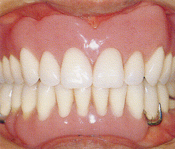 審美的で機能的な義歯に患者さんは満足なさっている。