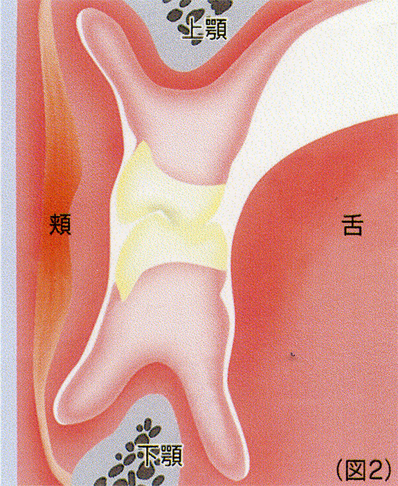 機能的な義歯は、デンチャースペースにバランスよくおさまっている。